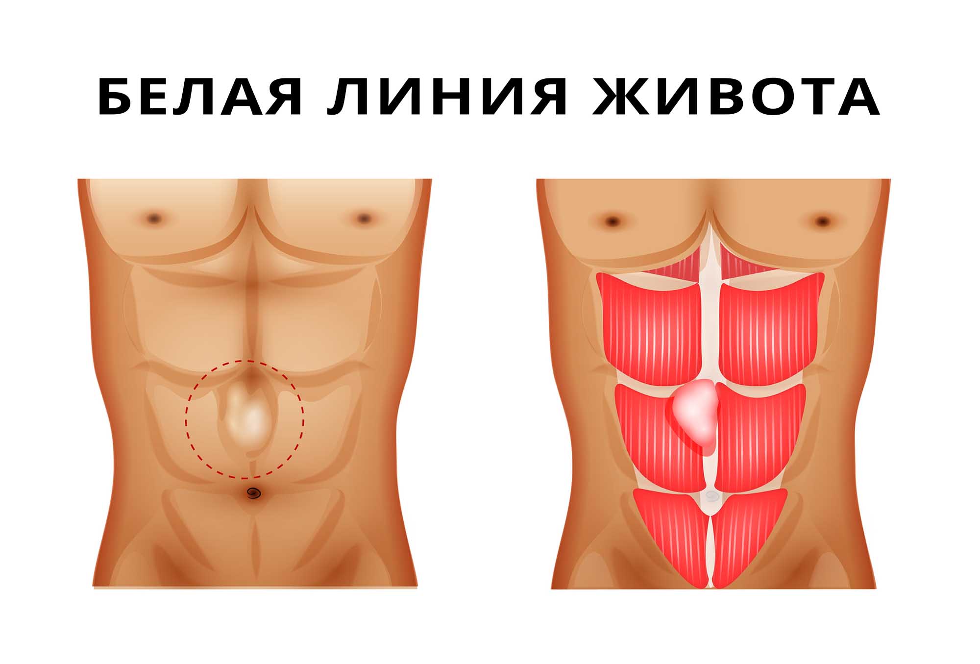 Грыжа белой линии живота